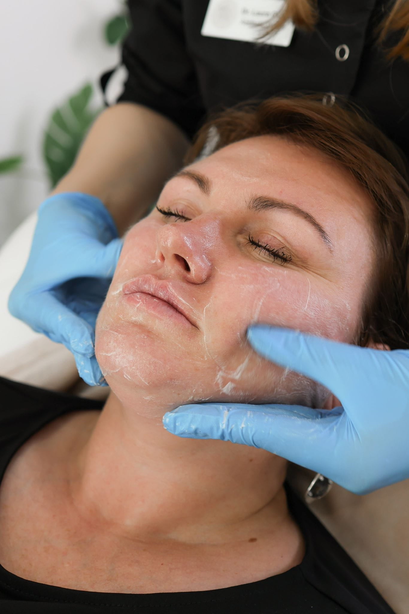 How to Choose the Right Cosmelan Depigmentation Peel Treatment in the UK