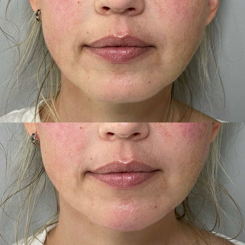 After Lip Filler When Can I Wear Lipstick