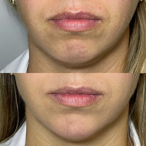 What filler is in a 5 point facelift?