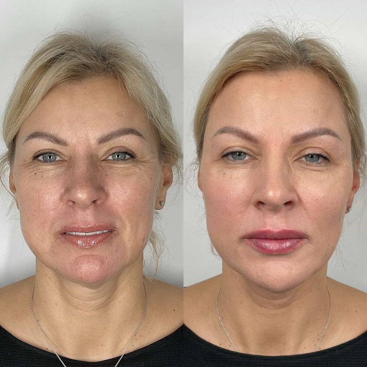 How does Radiesse Liquid Facelift help smooth out fine lines and wrinkles in Kingston Upon Thames