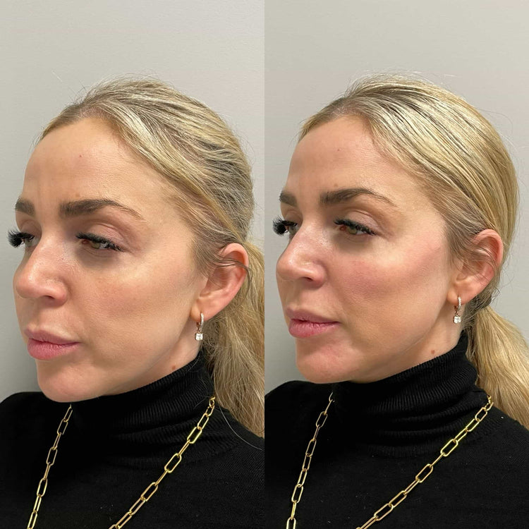 How does Radiesse Liquid Facelift help smooth out fine lines and wrinkles in Kingston Upon Thames