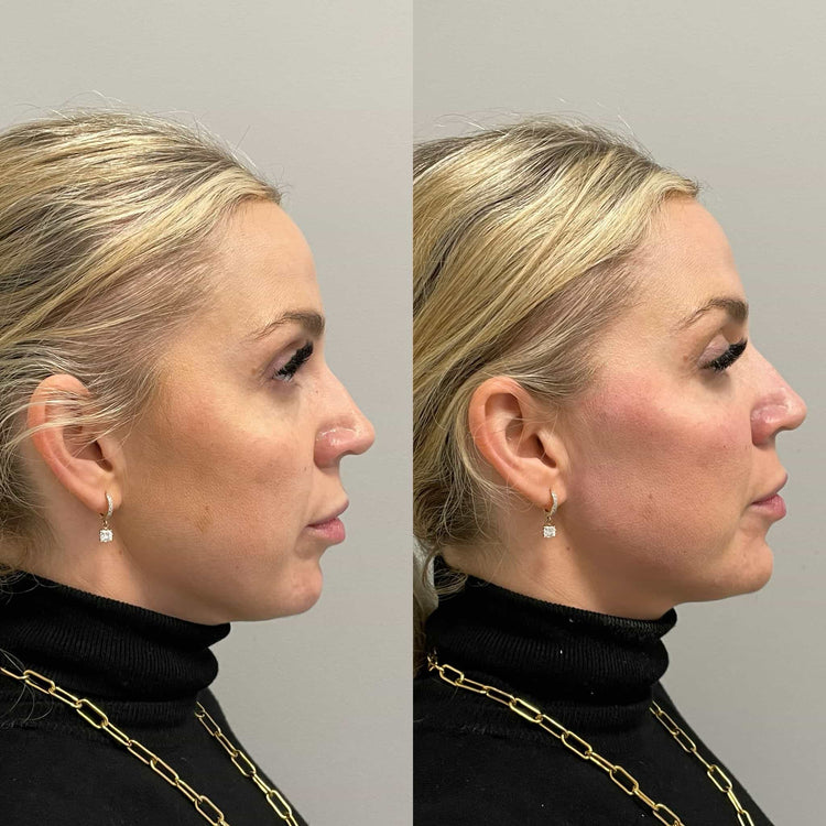 How does Radiesse Liquid Facelift help smooth out fine lines and wrinkles in Kingston Upon Thames
