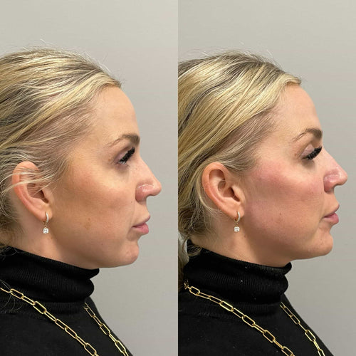 How Do You Know If Lip Filler Has Gone Wrong