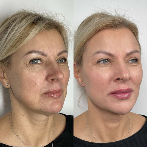 How much does an 8 point face lift cost?