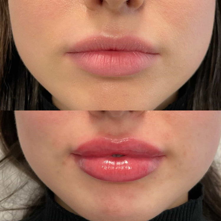 Top Areas for Dermal Filler Treatments in the UK