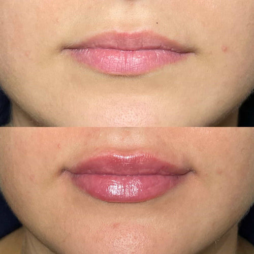 What Is The Best Non-Surgical Face Tightening Procedure?