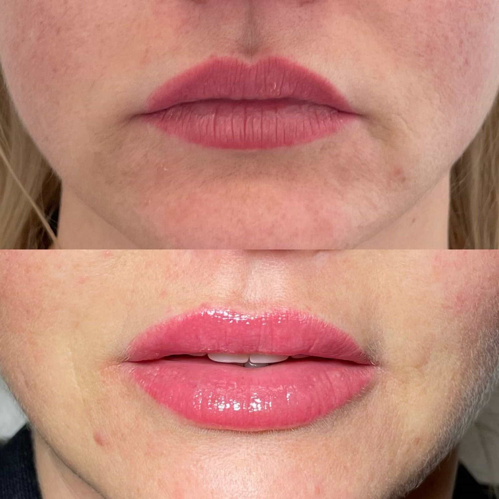 What Is The Smallest Amount Of Lip Filler