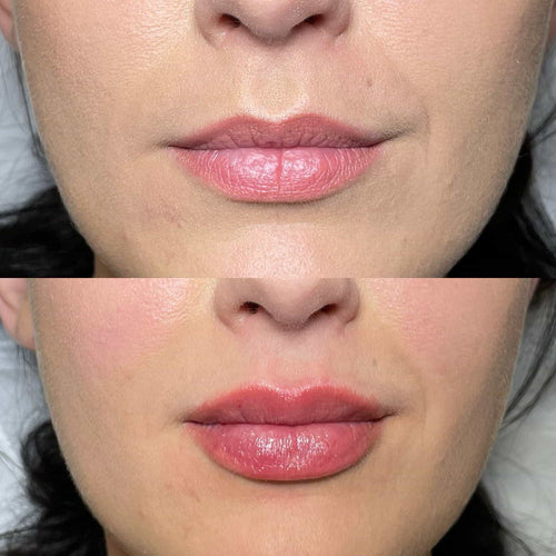 How To Stop Bruising After Lip Filler