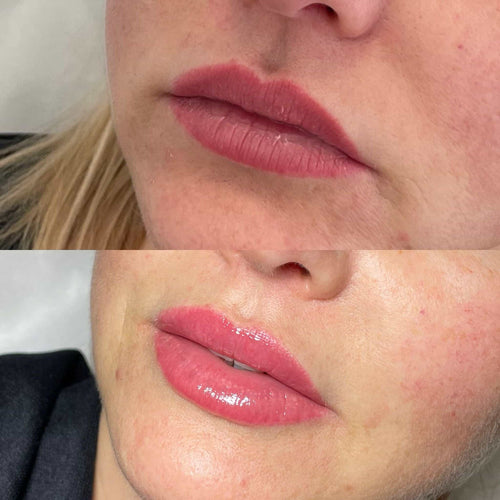 How To Stop Bruising After Lip Filler