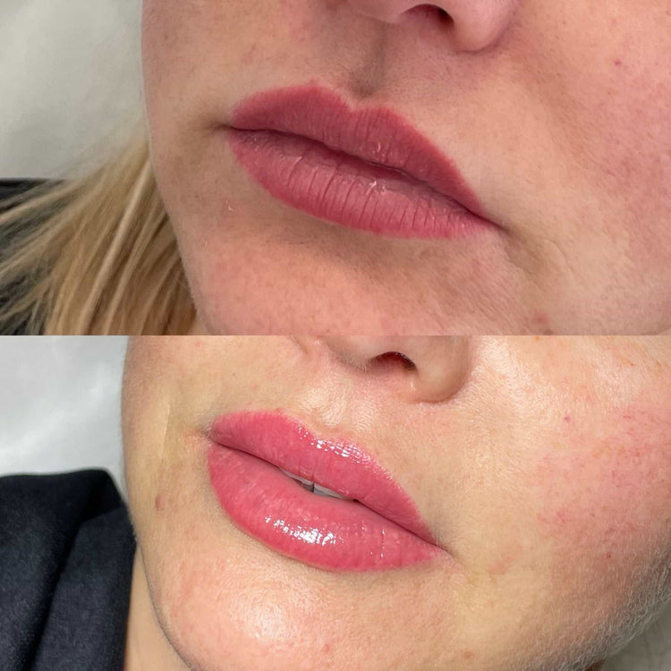 Are Lip Injections Safe for All Skin Types?