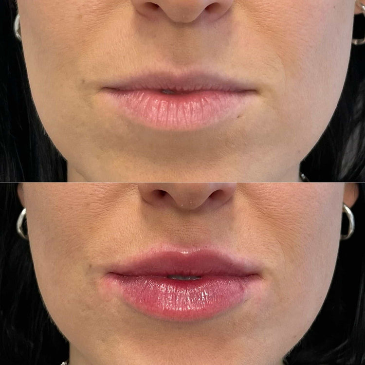 Are Lip Injections Safe for All Skin Types?