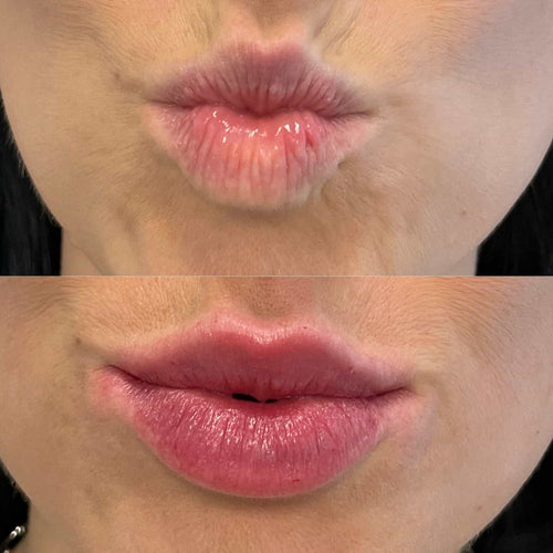 How Long After Lip Filler Can You Exercise