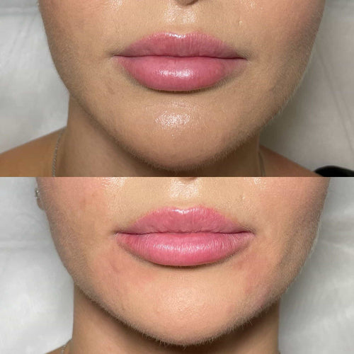 What Happens If You Drink After Lip Filler