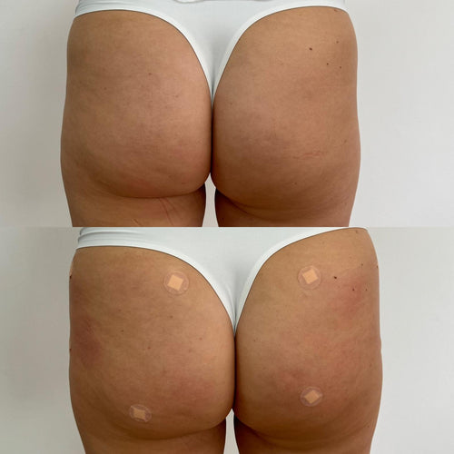 Non Surgical Butt Lift in Croydon Surrey
