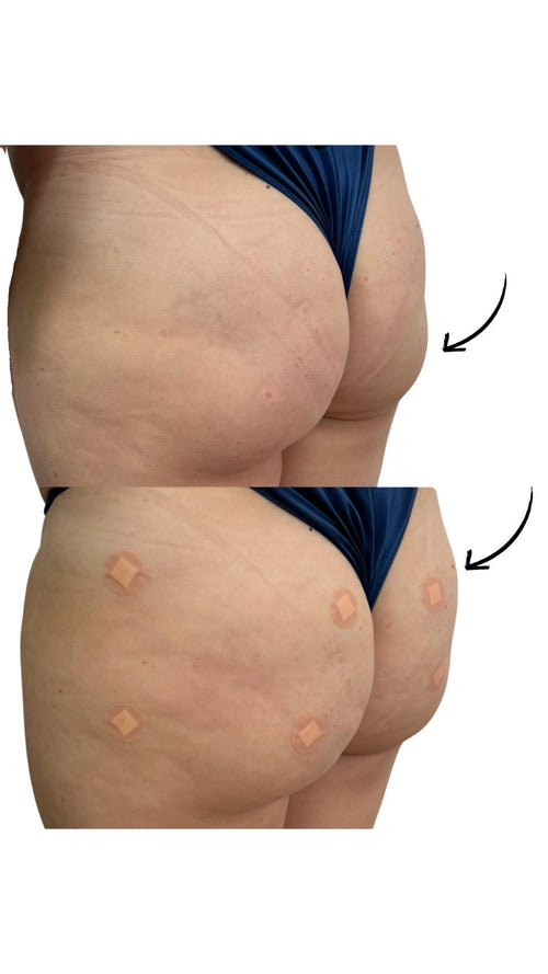 Non Surgical Butt Lift in Croydon Surrey
