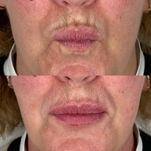 What Is The Best Non-Surgical Face Tightening Procedure?